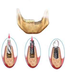 Kingsport dental implants