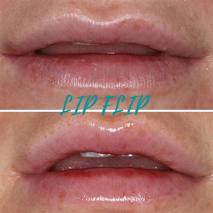 Lip Flip - Colonial Heights Dental Group