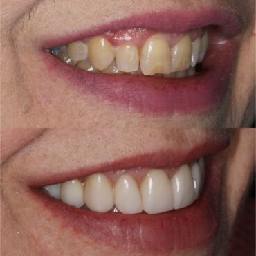 veneers3.jpg